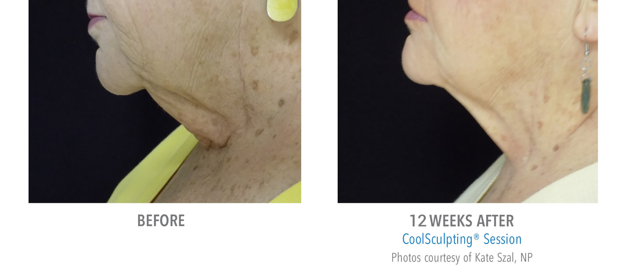 BA1 coolsculpting patient before and after