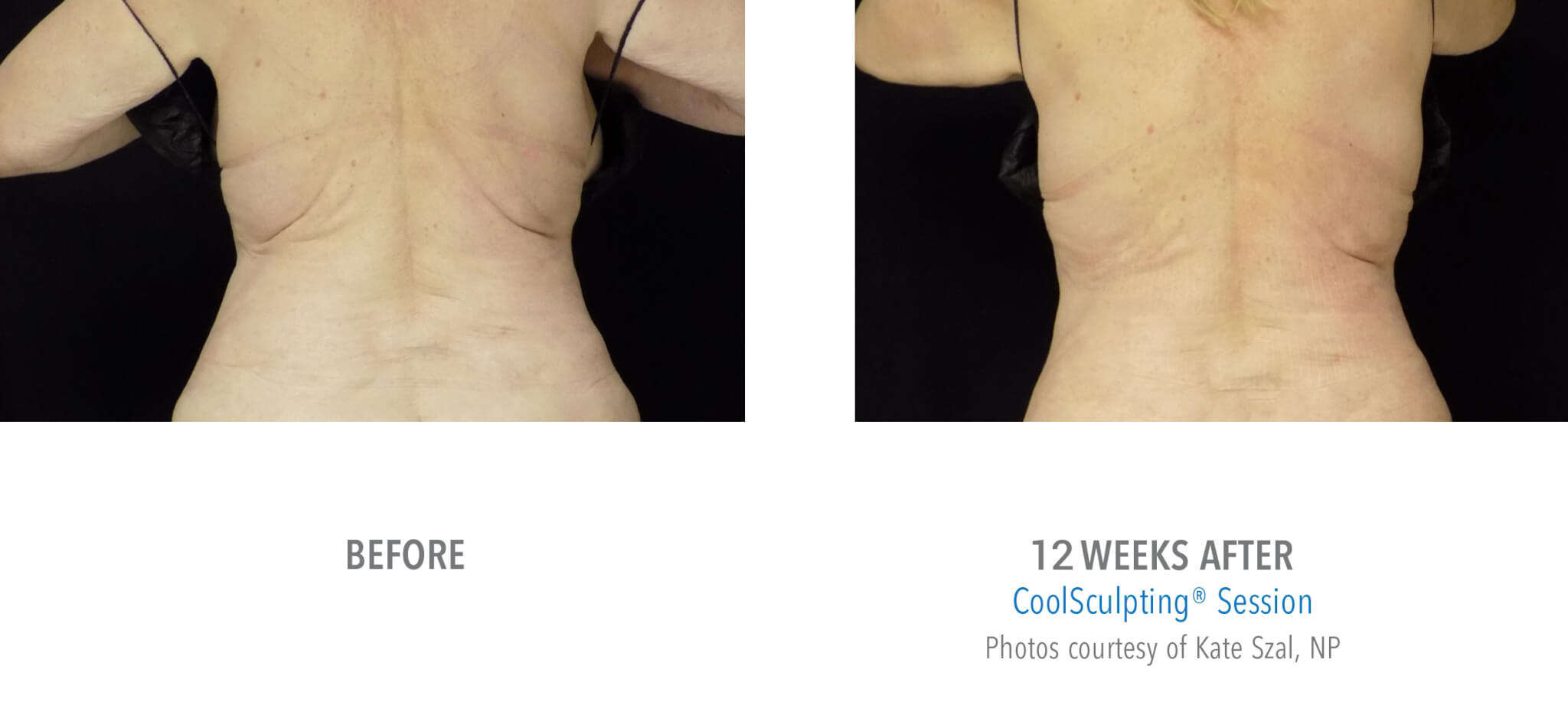 BA3 coolsculpting patient before and after