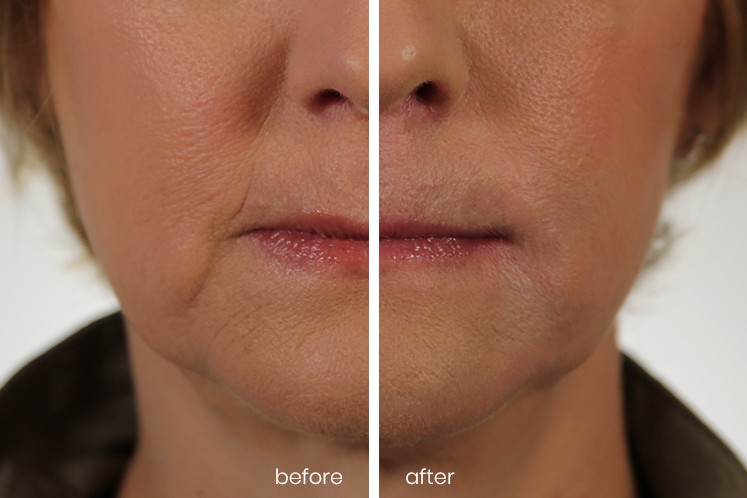 Revanesse Versa® patient before and after 5
