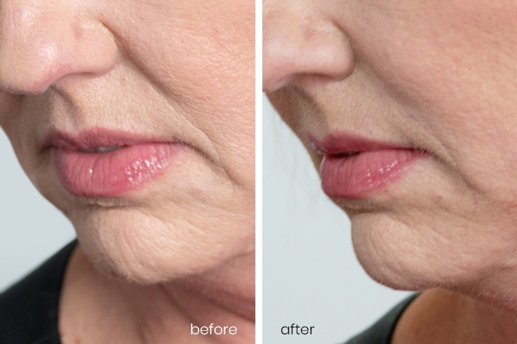 Revanesse Versa® patient before and after 4