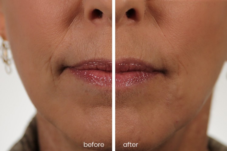 Revanesse Versa® patient before and after 3