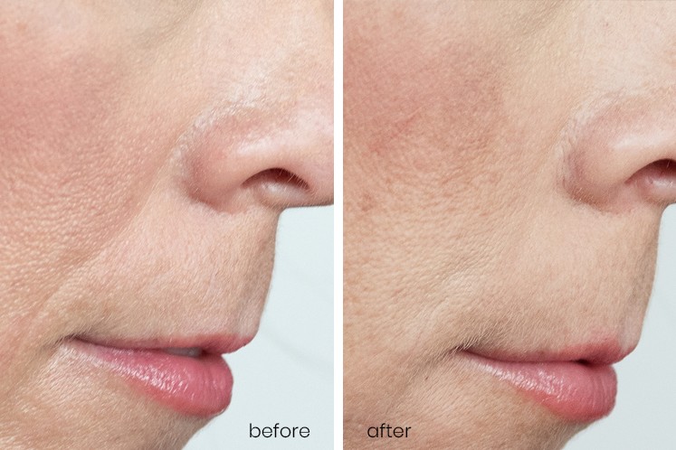 Revanesse Versa® patient before and after 2