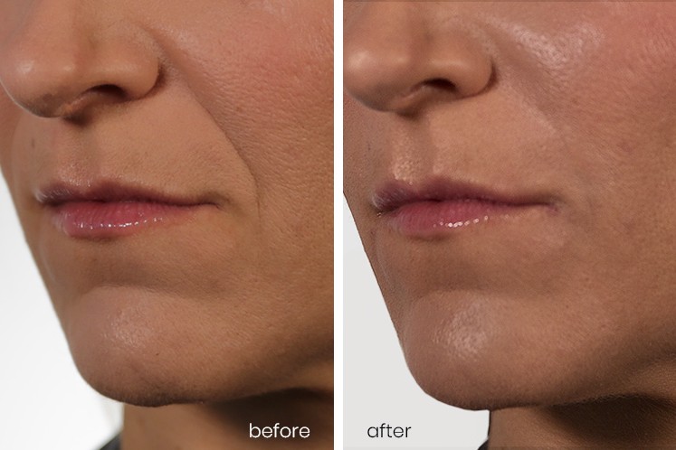 Revanesse Versa® patient before and after 1