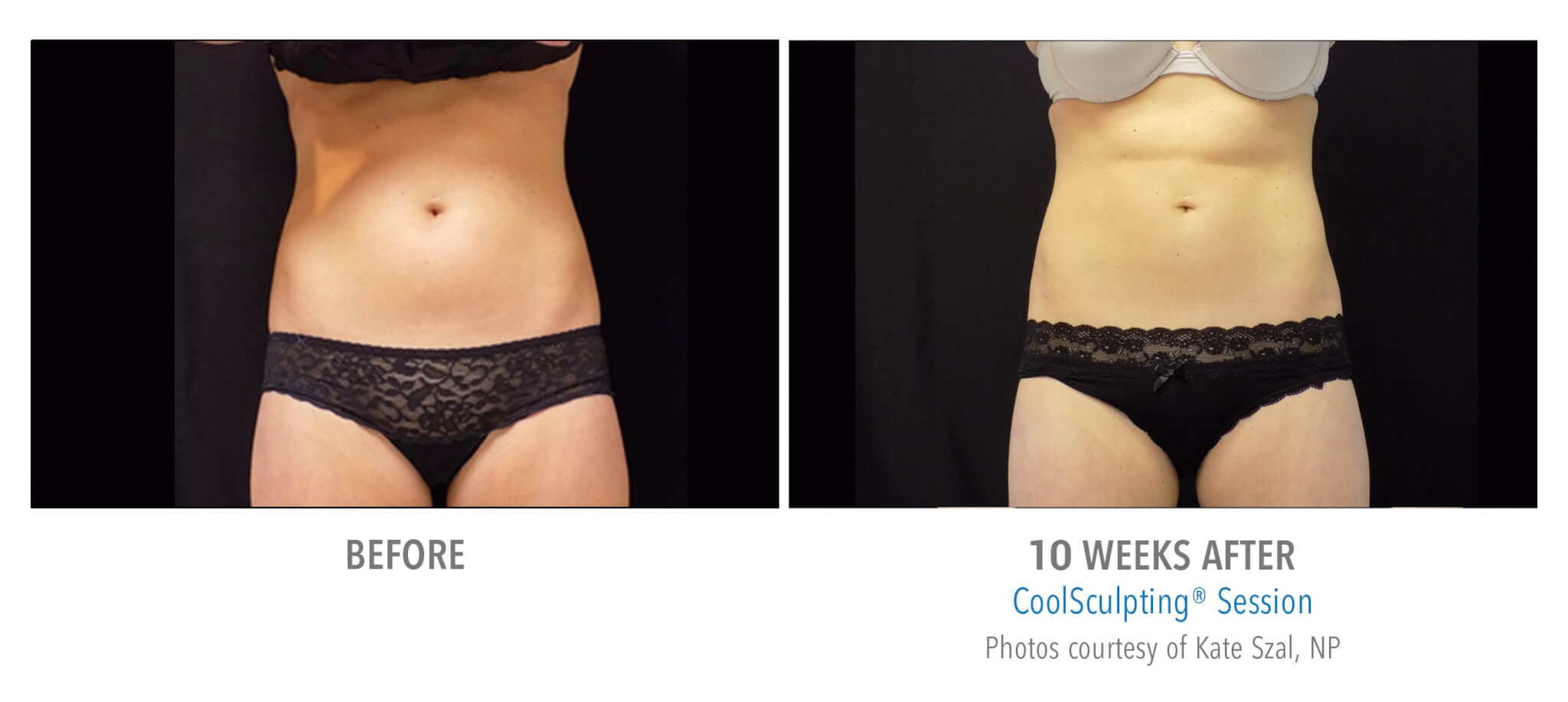 CS1 coolsculpting patient before and after