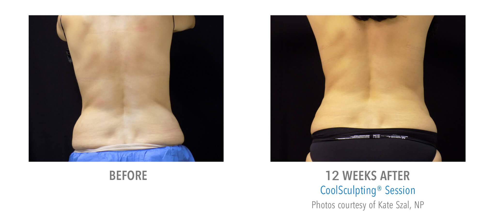 CS3 coolsculpting patient before and after