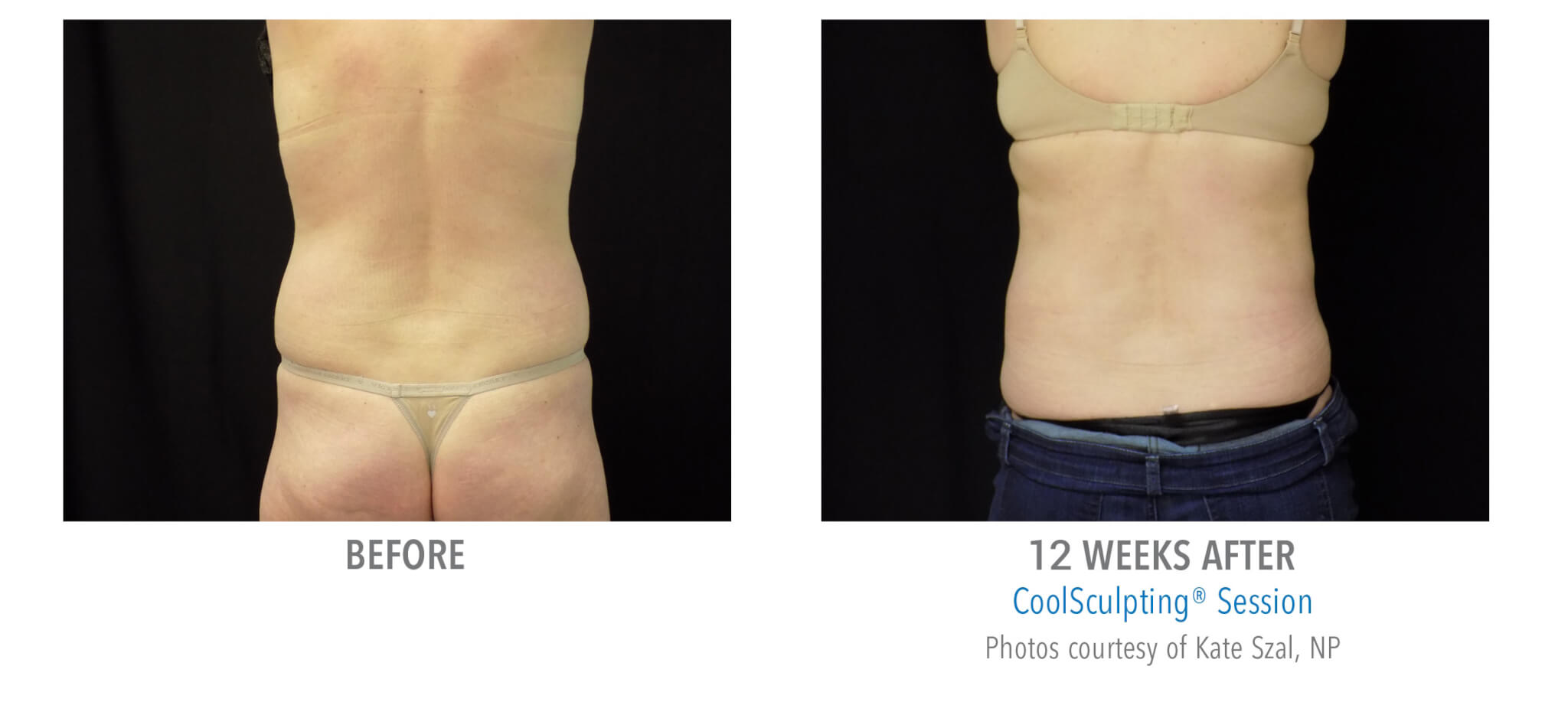 CS6 coolsculpting patient before and after