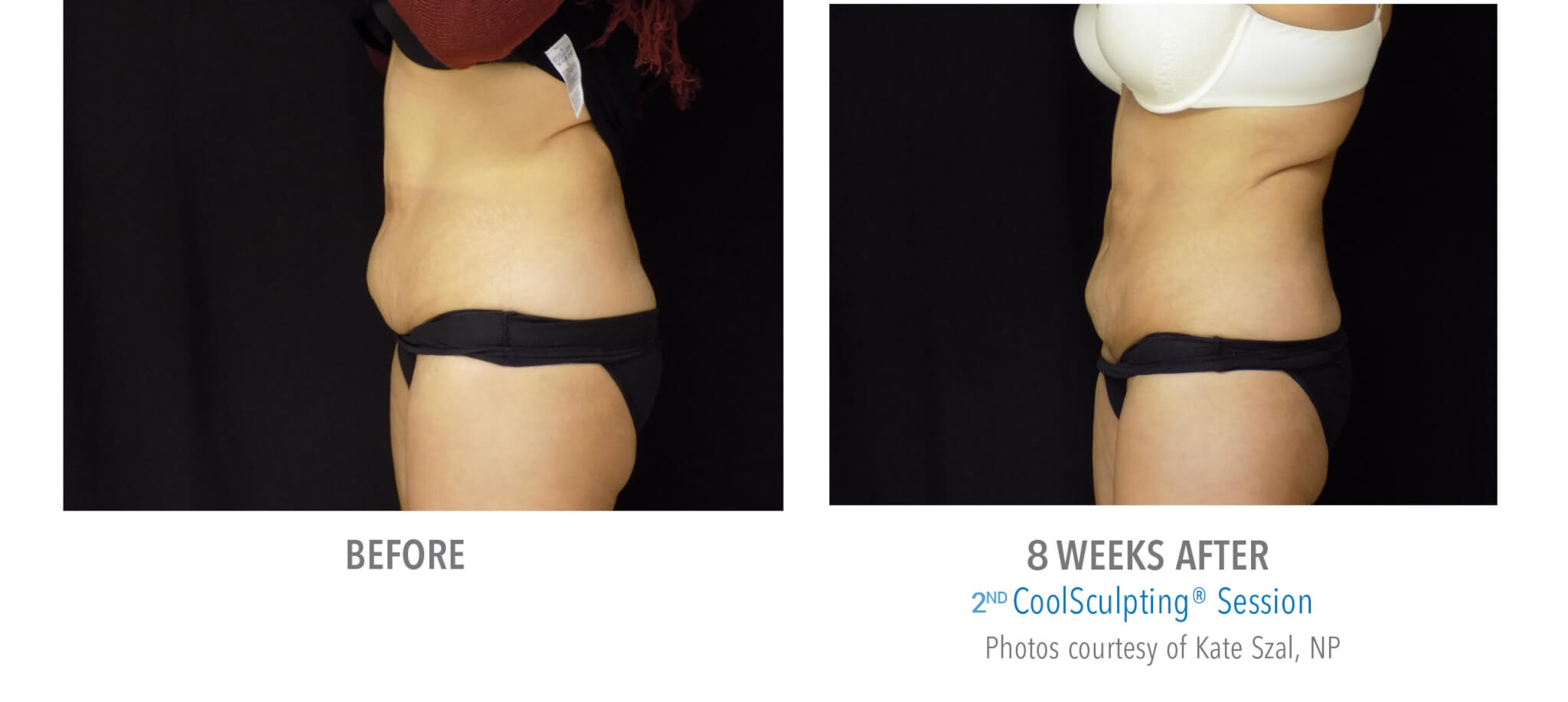 CS7 coolsculpting patient before and after