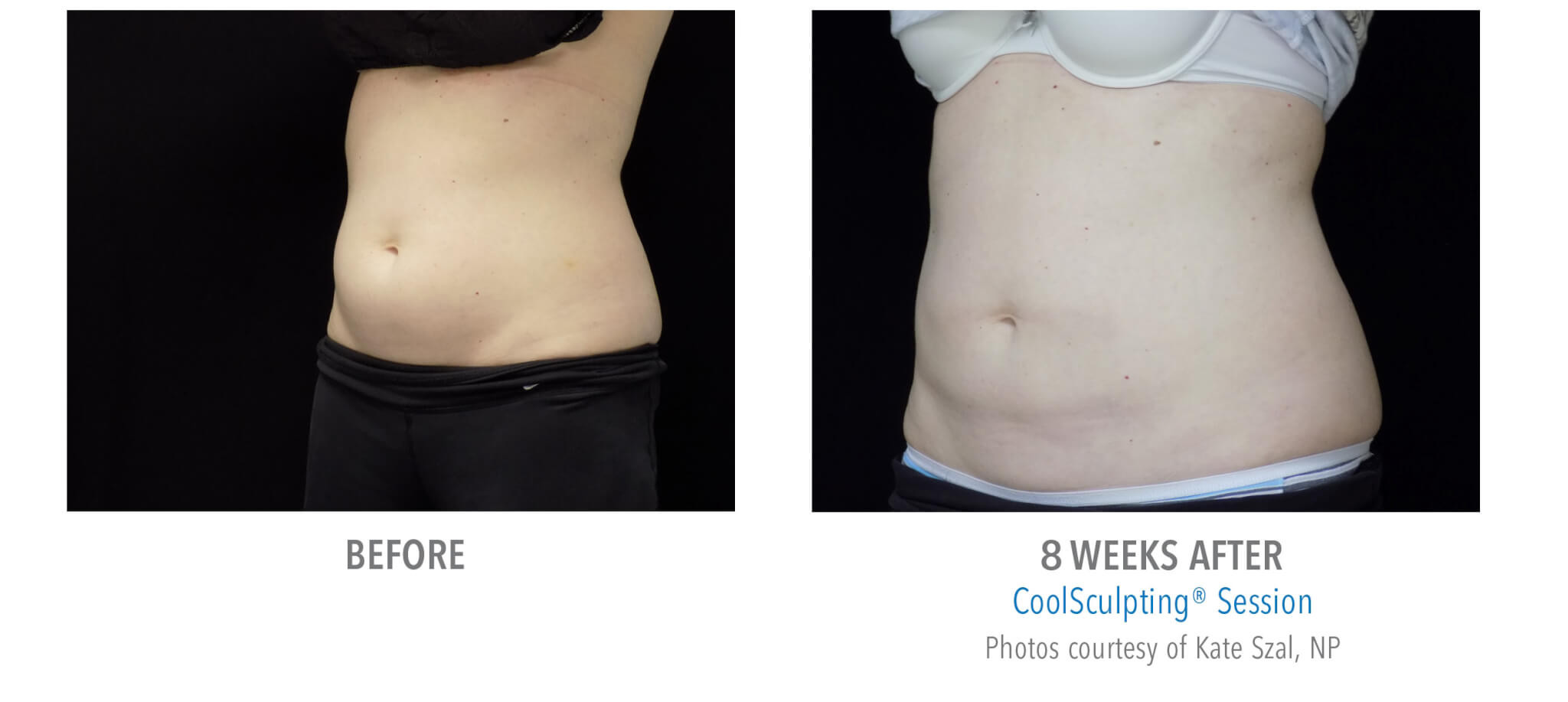 CS8 coolsculpting patient before and after