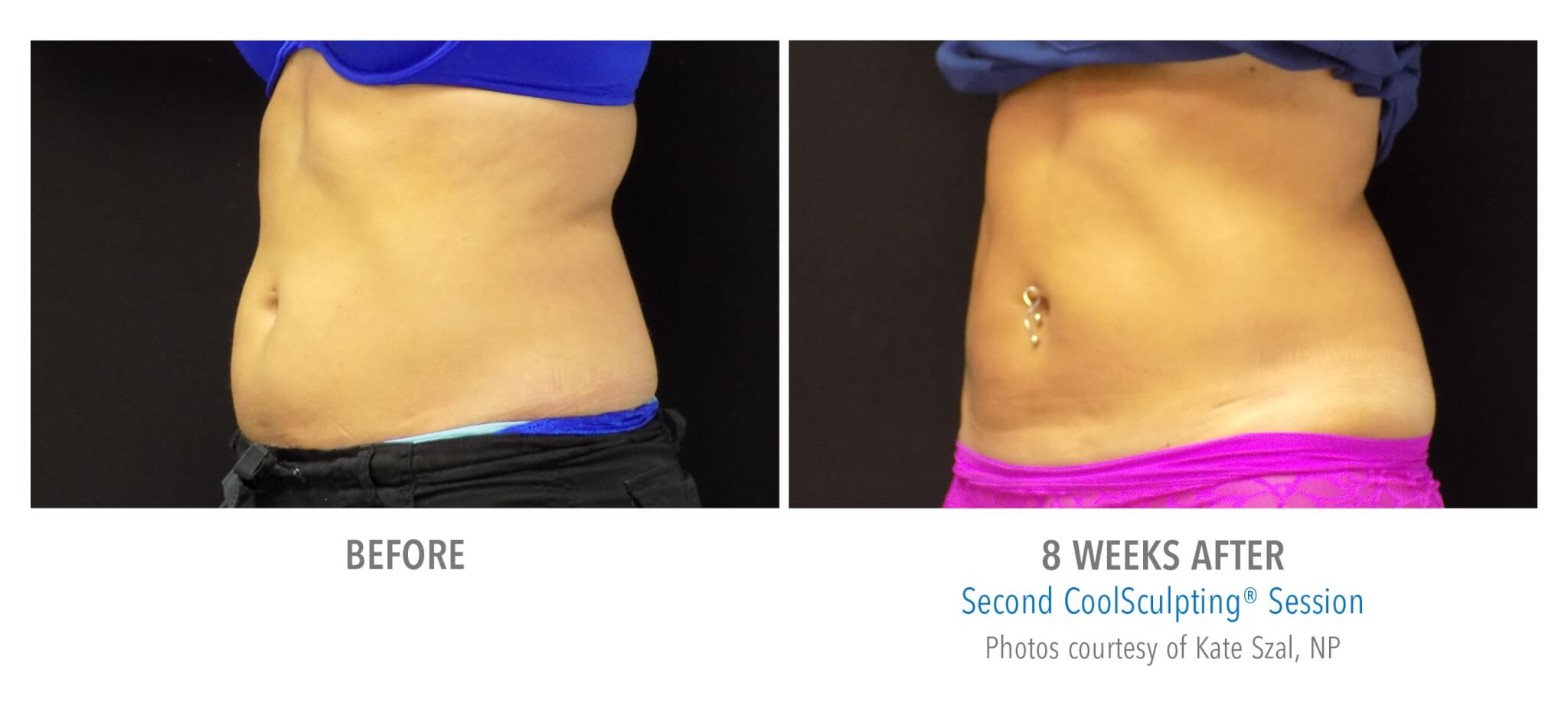 abdomen-angle-2 coolsculpting patient before and after