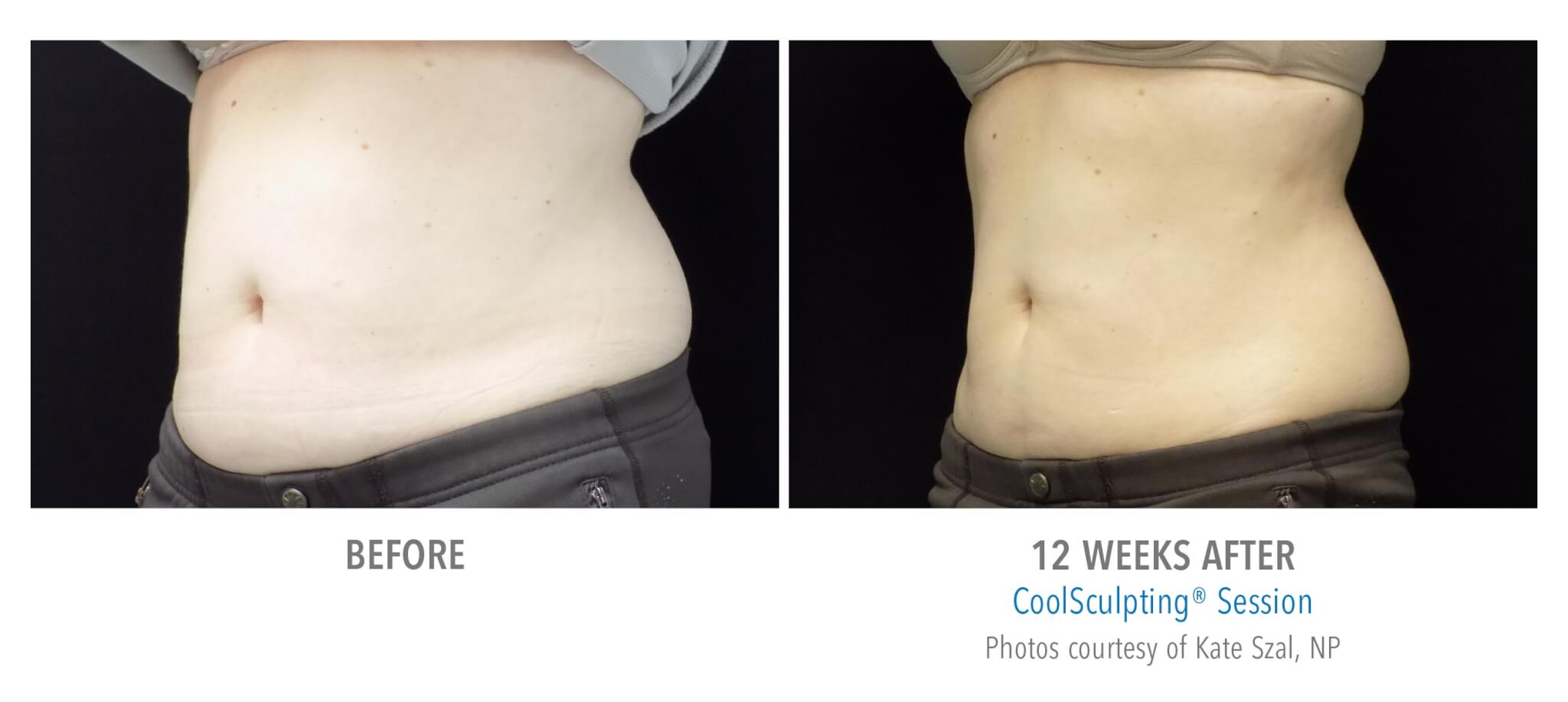 abdomen-angle coolsculpting patient before and after
