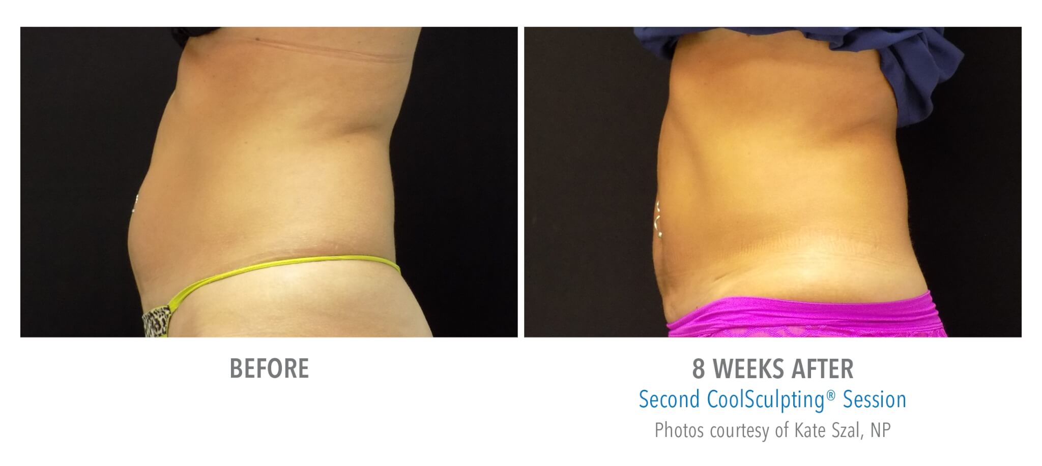 abdomen-side-2 coolsculpting patient before and after