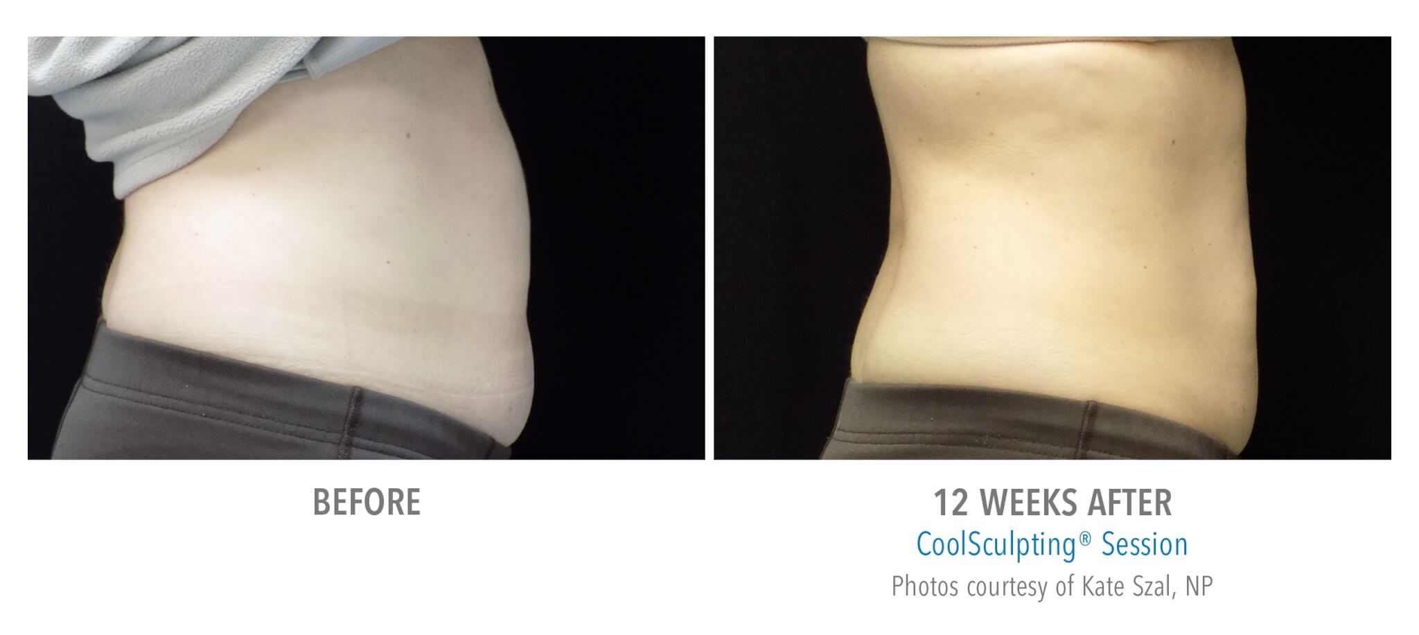 abdomen-side-3 coolsculpting patient before and after