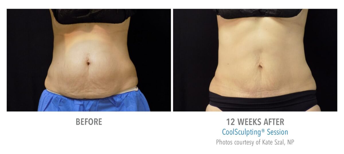 Coolsculpting Elite Non-Surgical Fat Loss in Fall River, MA