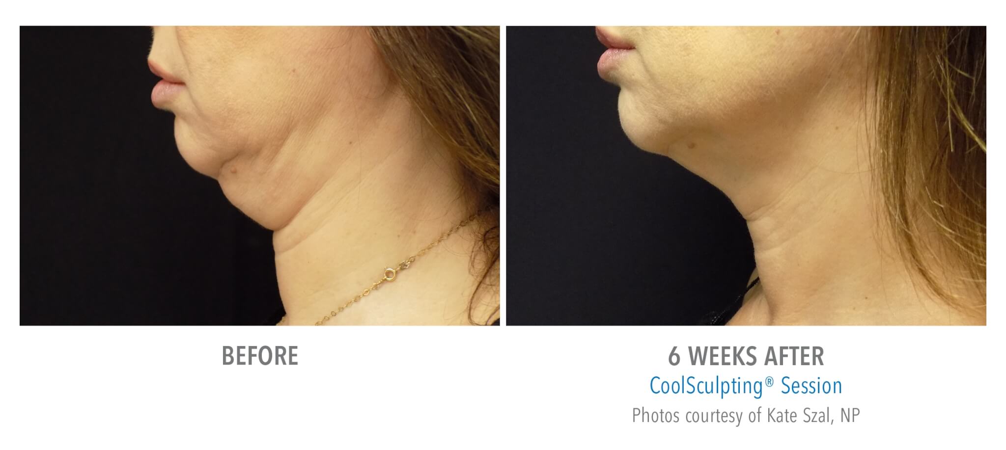neck-side coolsculpting patient before and after