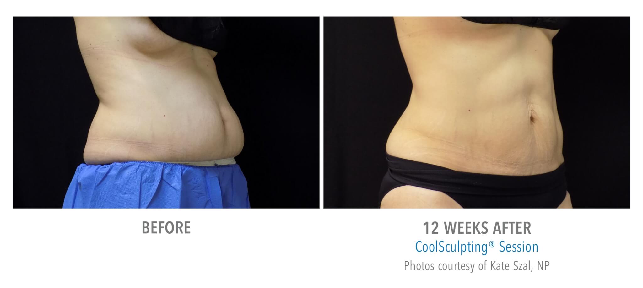 pt46-1 coolsculpting patient before and after