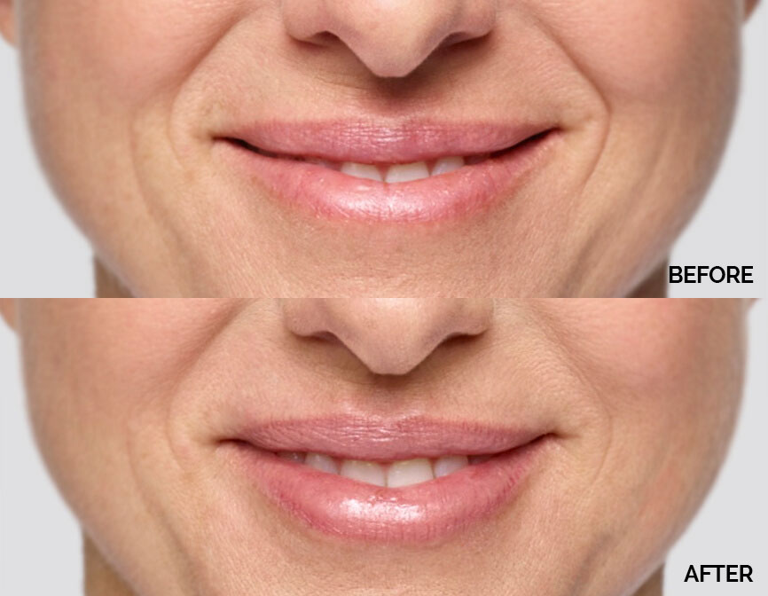 Restylane® patient before and after 2