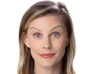 Womans forehead before botox at Aspireabody