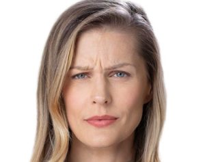 Womans face before botox treatment with Aspireabody